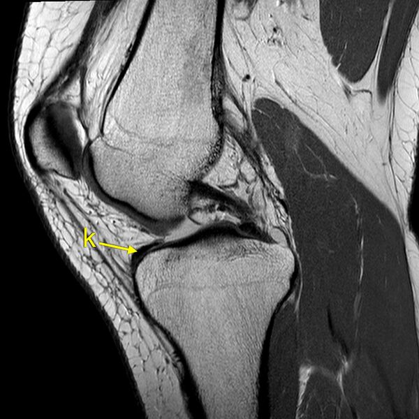 File:Anatomy Quiz (MRI knee) (Radiopaedia 43478-46865 A 10).jpeg
