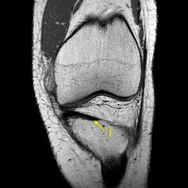File:Anatomy Quiz (MRI knee) (Radiopaedia 43478-46874 A 9).jpeg