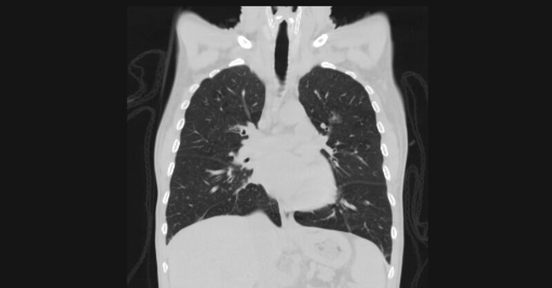 File:Angioinvasive aspergellosis (Radiopaedia 66995-76315 Coronal lung window 30).jpg