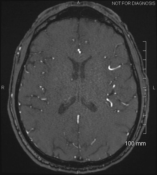File:Anterior cerebral artery aneurysm (Radiopaedia 80683-94127 Axial MRA 146).jpg