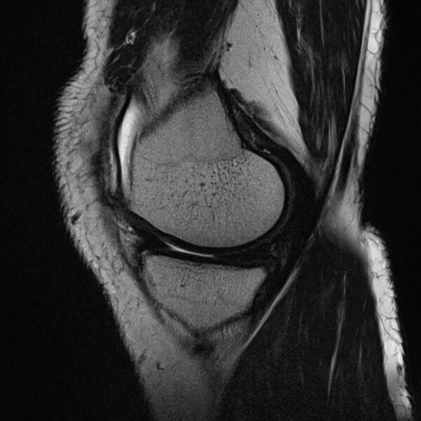 File:Anterior cruciate ligament tear - ramp lesion (Radiopaedia 71883-82322 Sagittal T2 19).jpg