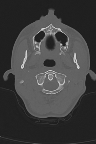 File:Anterior nasal spine fracture (Radiopaedia 46138-50494 Axial bone window 56).png