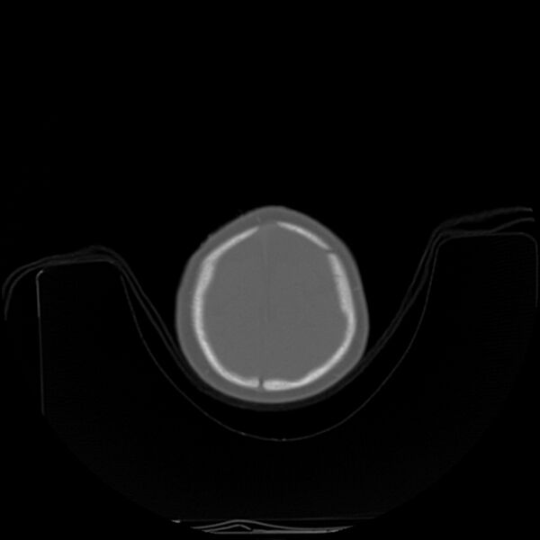 File:Anterior plagiocephaly (Radiopaedia 71836-82273 C 93).jpg