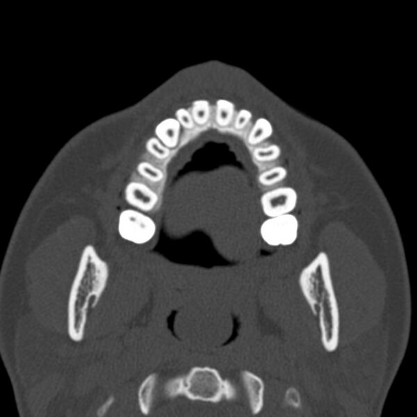 File:Antrochoanal polyp (Radiopaedia 21894-21868 Axial bone window 3).jpg