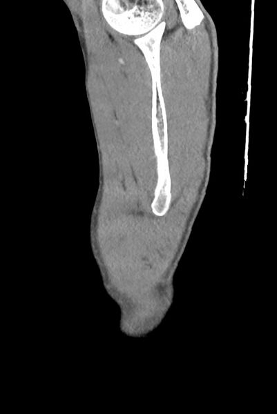 File:Aortic coarctation with aneurysm (Radiopaedia 74818-85828 B 9).jpg