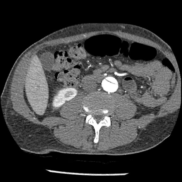 File:Aortic dissection - DeBakey Type I-Stanford A (Radiopaedia 79863-93115 A 57).jpg