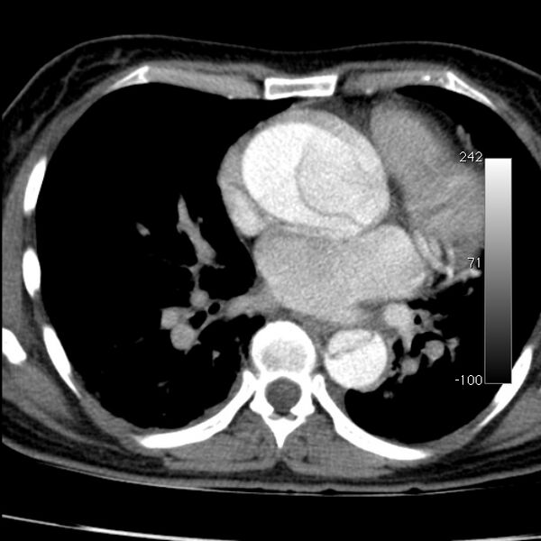 File:Aortic dissection - Stanford type A (Radiopaedia 29247-29659 A 46).jpg