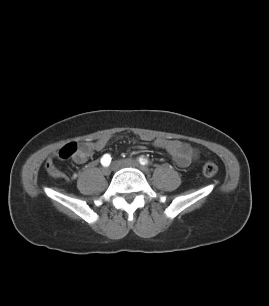 File:Aortic dissection with renal ischemia (Radiopaedia 76573-88338 A 89).jpg