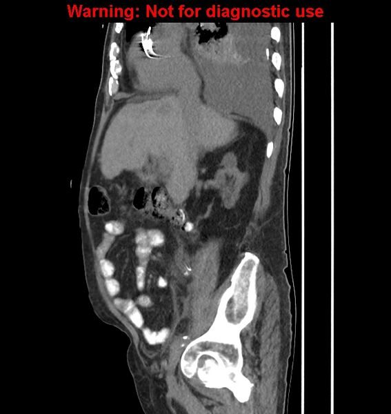 File:Aortic graft infection (Radiopaedia 44979-48907 C 46).jpg