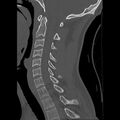 Apical pneumothorax on cervical spine CT (Radiopaedia 45343-49368 Sagittal bone window 15).jpg