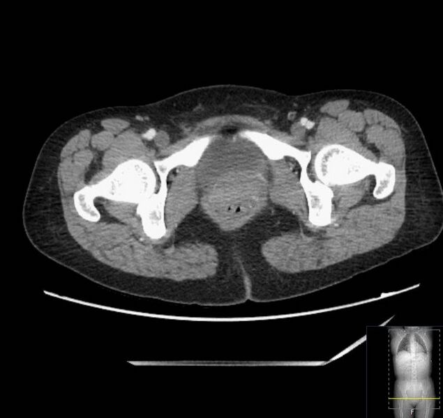 File:Appendicitis (CT angiogram) (Radiopaedia 154713-127660 Axial 80).jpg