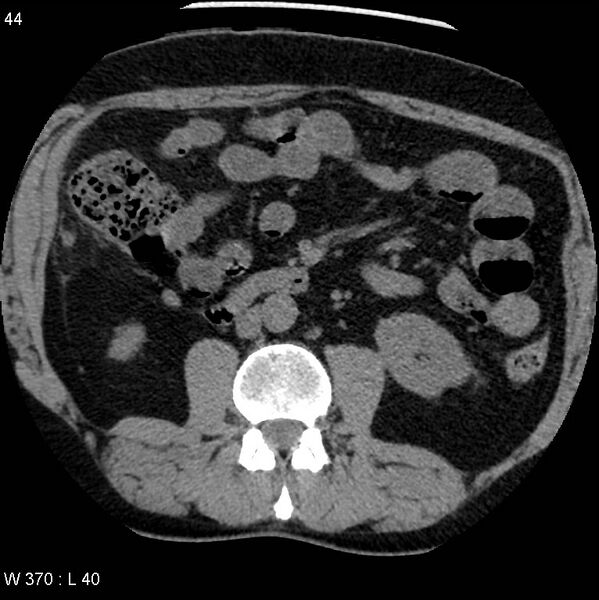 File:Appendicitis (Radiopaedia 12510-12733 Axial non-contrast 11).jpg