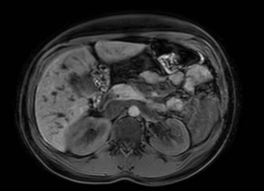 Appendicitis in gravida (MRI) (Radiopaedia 89433-106395 Axial DIXON 42).jpg