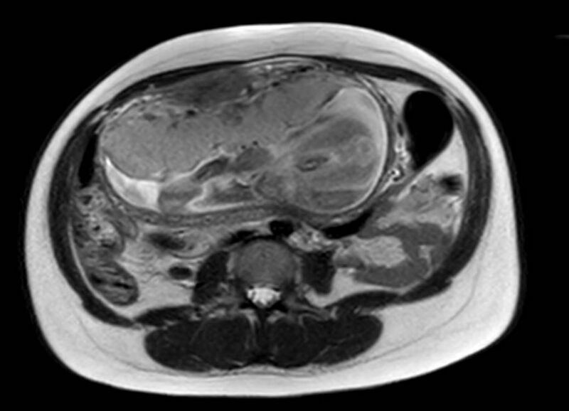File:Appendicitis in gravida (MRI) (Radiopaedia 89433-106395 Axial T2 35).jpg