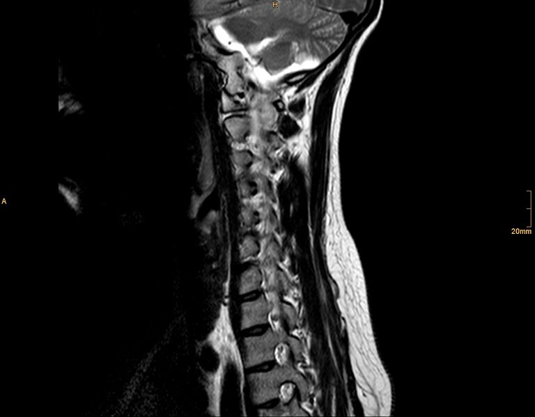 File:Arachnoid cyst - spinal (Radiopaedia 10055-10597 T2 4).jpg