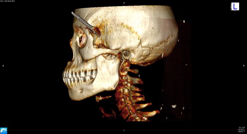 File:Arrow injury to the head (Radiopaedia 75266-86388 3D horizontal 20).jpg