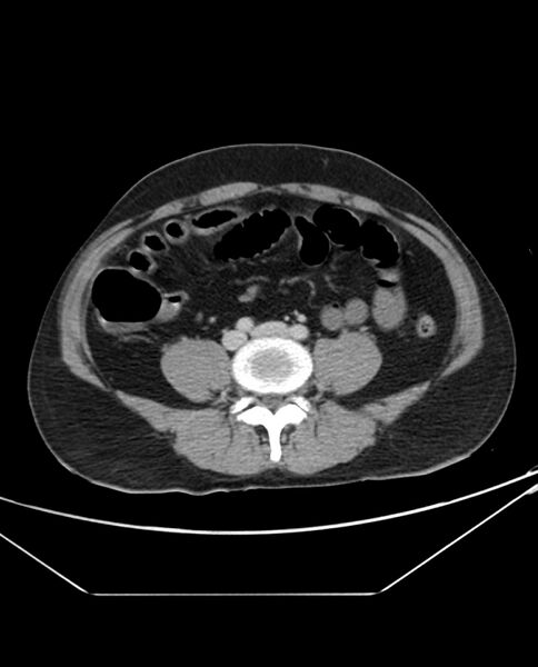 File:Arterial occlusive mesenteric ischemia (Radiopaedia 84641-100054 A 77).jpg