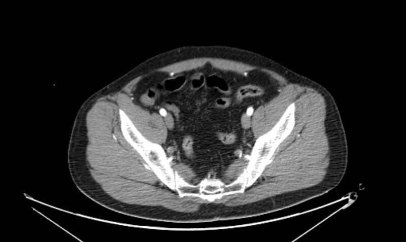 File:Arterial occlusive mesenteric ischemia (Radiopaedia 84641-100060 A 109).jpg