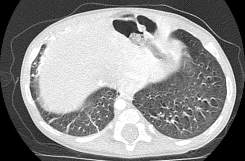 File:Asplenia syndrome (Radiopaedia 73083-83792 Axial lung window 63).jpg