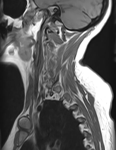File:Astrocytoma - spinal cord (Radiopaedia 69769-79758 Sagittal T1 1).jpg