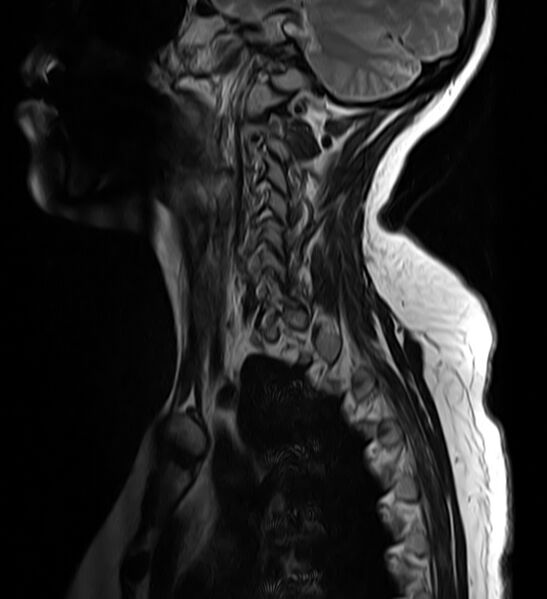 File:Astrocytoma - spinal cord (Radiopaedia 69769-79758 Sagittal T2 2).jpg
