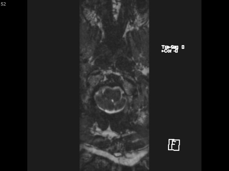 File:Atypical meningioma - intraosseous (Radiopaedia 64915-74572 Axial CISS 52).jpg