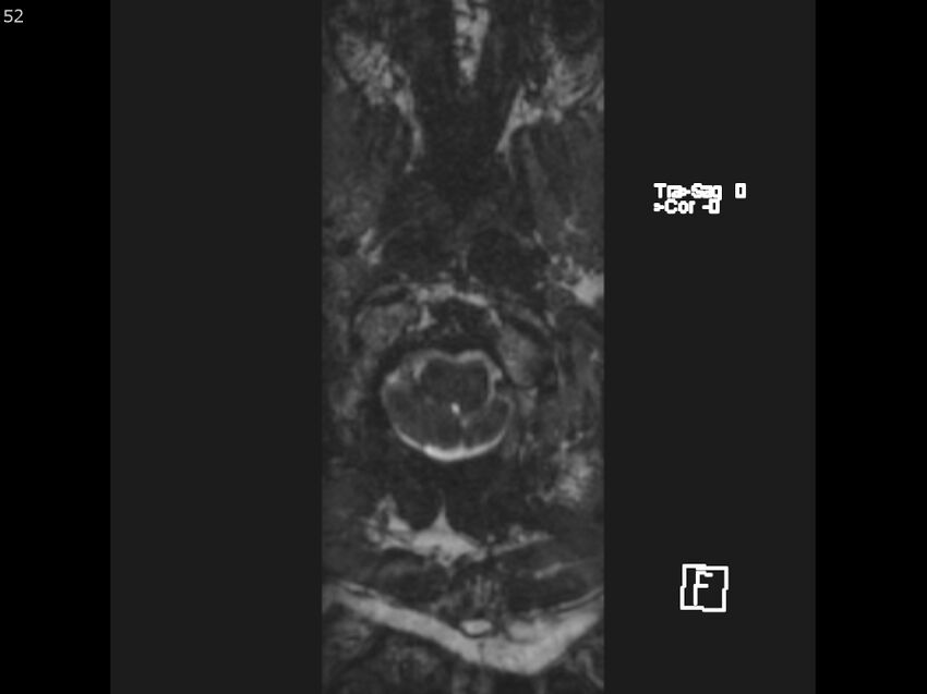Atypical meningioma - intraosseous (Radiopaedia 64915-74572 Axial CISS 52).jpg