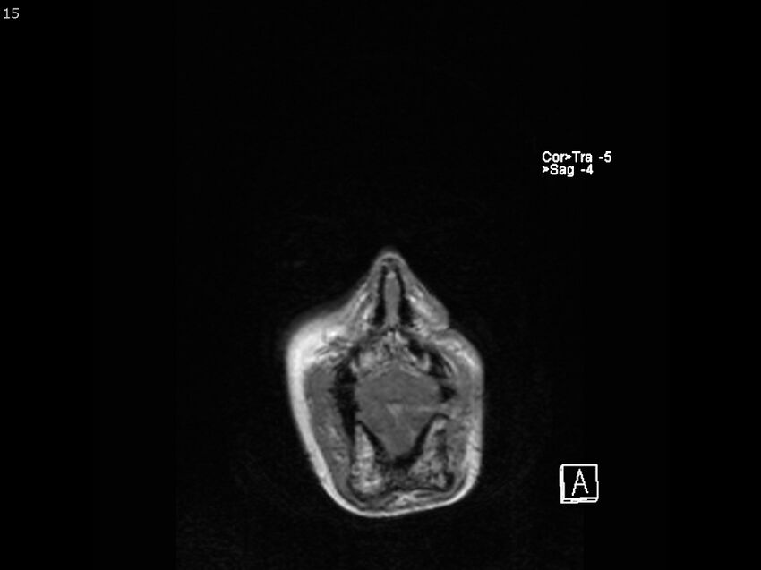 Atypical meningioma - intraosseous (Radiopaedia 64915-74572 Coronal T1 15).jpg