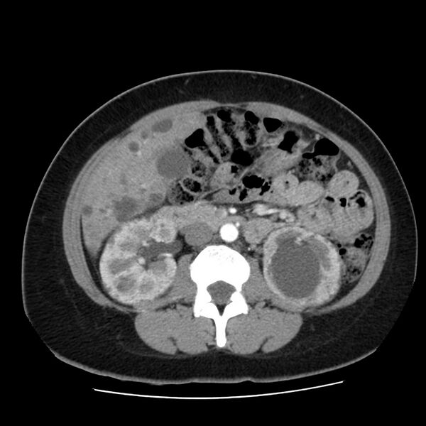 File:Autosomal dominant polycystic kidney disease (Radiopaedia 23061-23093 B 32).jpg