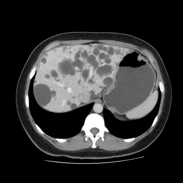 File:Autosomal dominant polycystic kidney disease (Radiopaedia 23061-23093 C 13).jpg