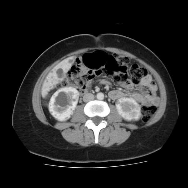 File:Autosomal dominant polycystic kidney disease (Radiopaedia 23061-23093 C 36).jpg