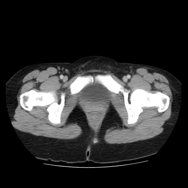 File:Autosomal dominant polycystic kidney disease (Radiopaedia 23061-23093 C 72).jpg