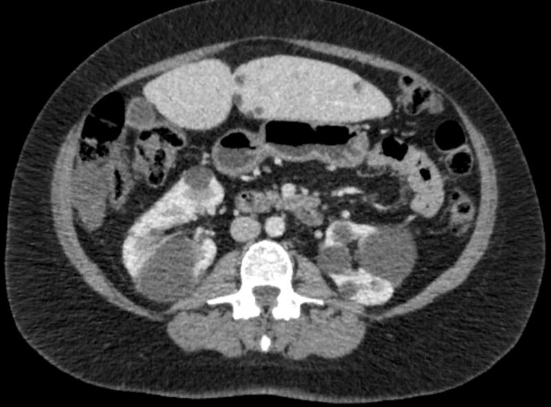 File:Autosomal dominant polycystic kidney disease (Radiopaedia 57124-64017 A 58).jpg