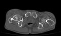 Avascular necrosis of the left hip (Radiopaedia 75068-86125 Axial bone window 74).jpg