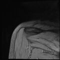 Avulsion fracture - greater tuberosity of humerus (Radiopaedia 71216-81515 Coronal T2 4).jpg