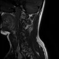 Axis fracture - MRI (Radiopaedia 71925-82375 Sagittal T1 9).jpg