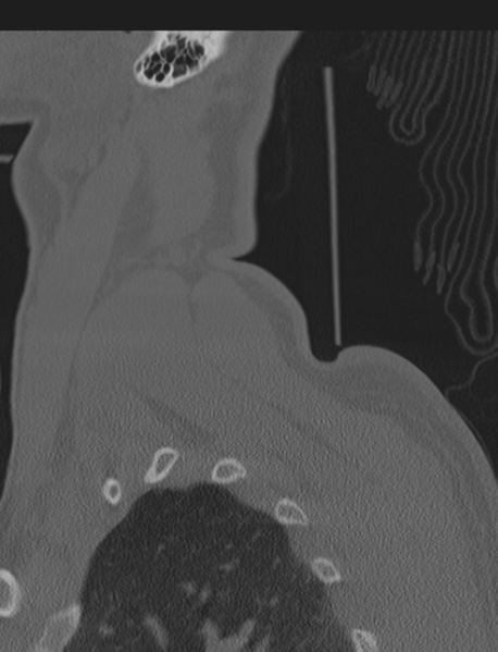 File:Axis peg fracture (type 3) and atlas lateral mass (type 4) fracture (Radiopaedia 37474-39324 Sagittal bone window 75).png