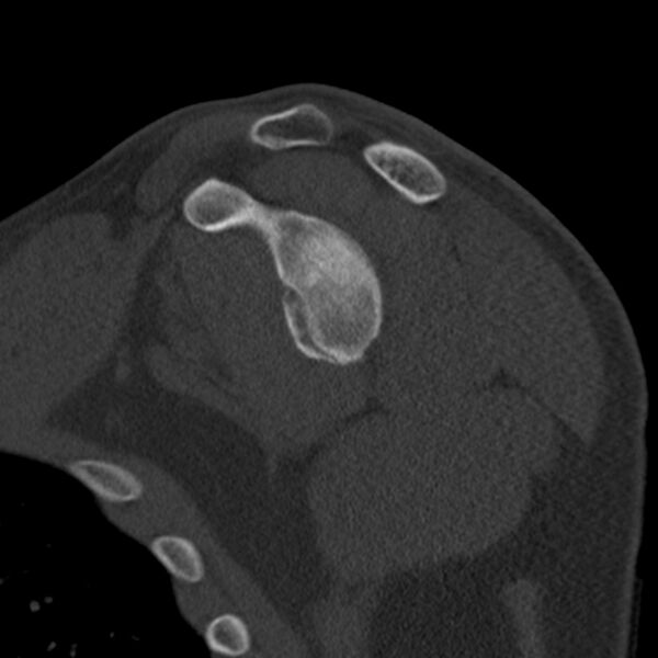 File:Bankart lesion (Radiopaedia 22771-22798 Sagittal bone window 29).jpg