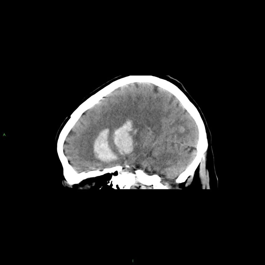 Basal ganglia hemorrhage (Radiopaedia 58349-65472 C 31).jpg