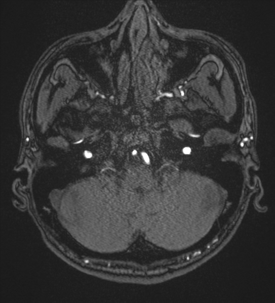 File:Basal ganglia subacute infarct (Radiopaedia 80201-93521 Axial MRA 3).png