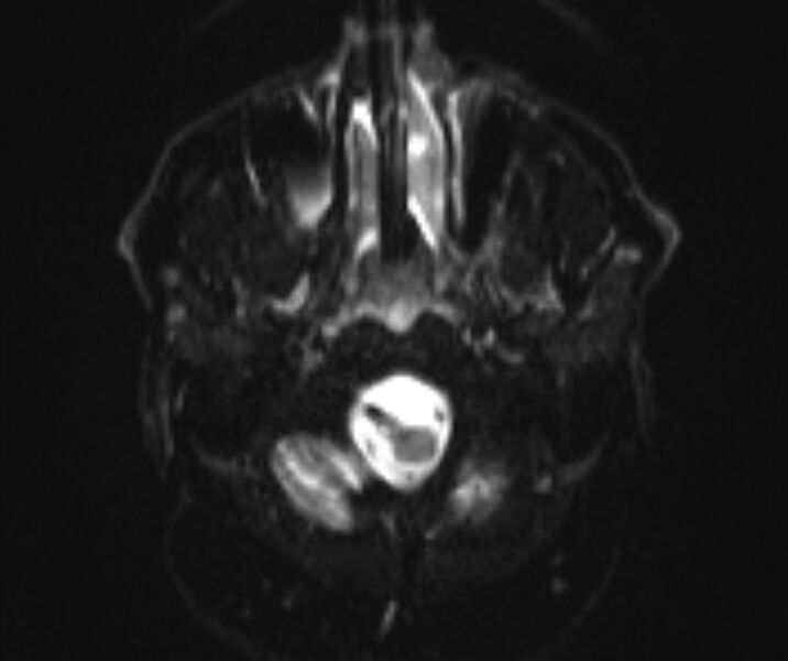 File:Basilar artery dissection (Radiopaedia 77032-88976 Axial DWI 2).jpg