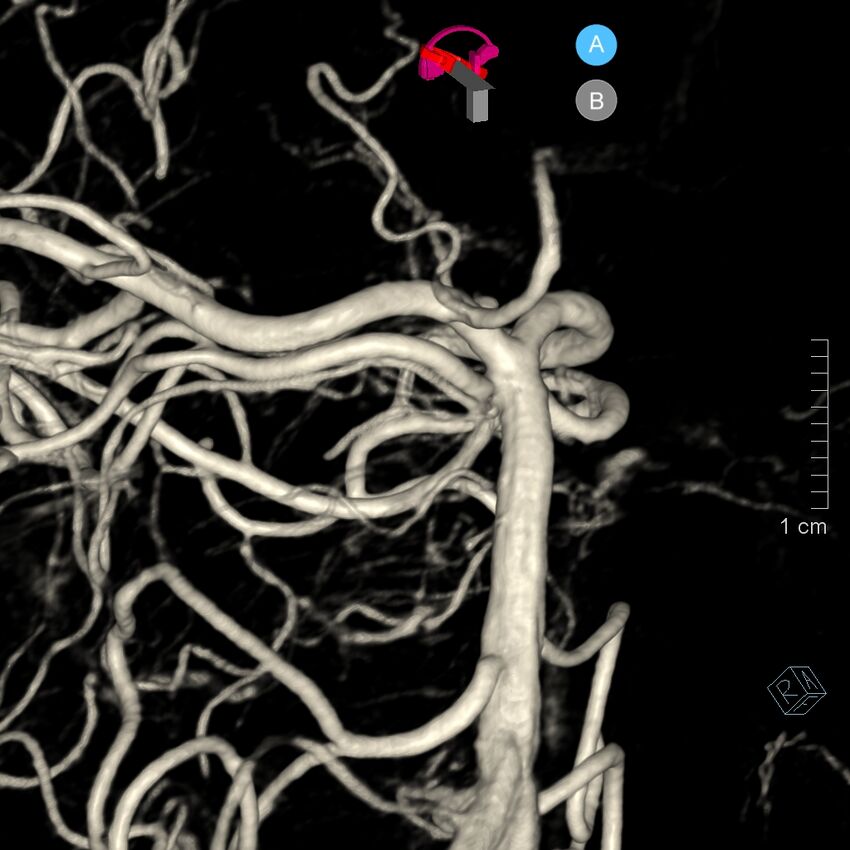 Basilar artery perforator aneurysm (Radiopaedia 82455-97734 3D view left VA 128).jpg