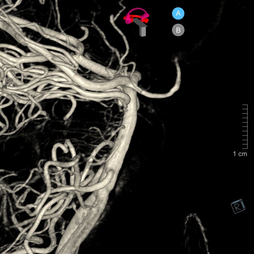 Basilar artery perforator aneurysm (Radiopaedia 82455-97734 3D view left VA 63).jpg