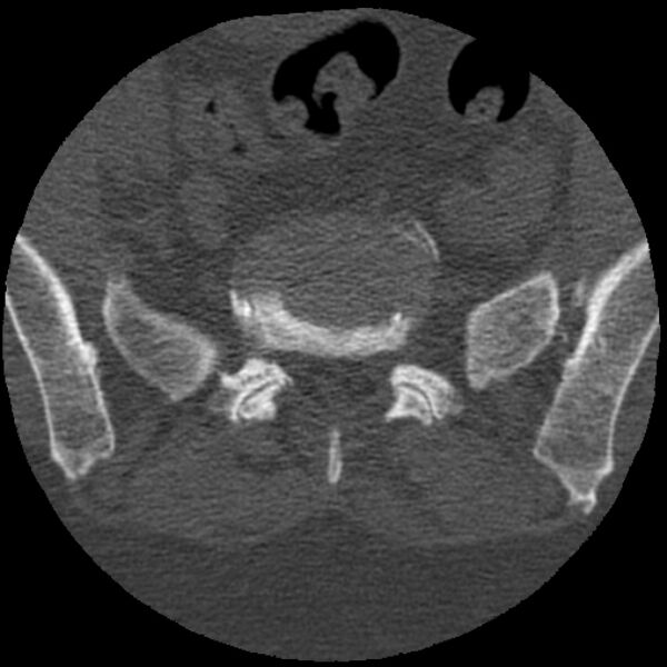 File:Bertolotti syndrome (Radiopaedia 24864-25128 Axial bone window 31).jpg