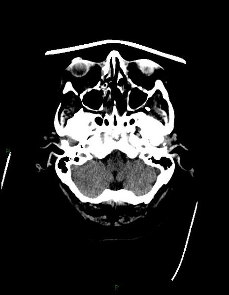 File:Bilateral acute middle cerebral artery territory infarcts (Radiopaedia 77319-89401 Axial non-contrast 12).jpg