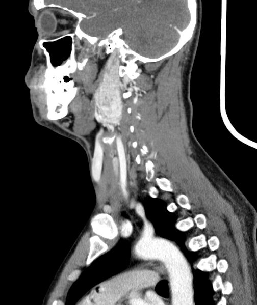 File:Bilateral carotid body tumors (Radiopaedia 52899-58827 C 38).jpg