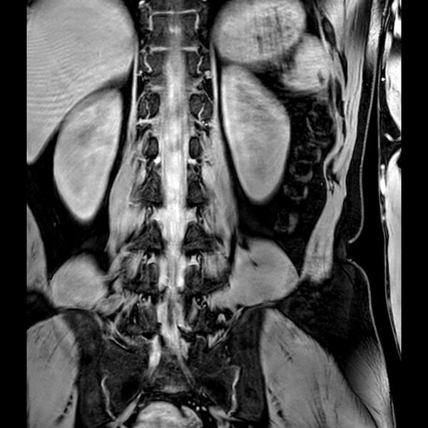 File:Bilateral conjoined nerve roots at different levels (Radiopaedia 73312-84063 B 32).jpg