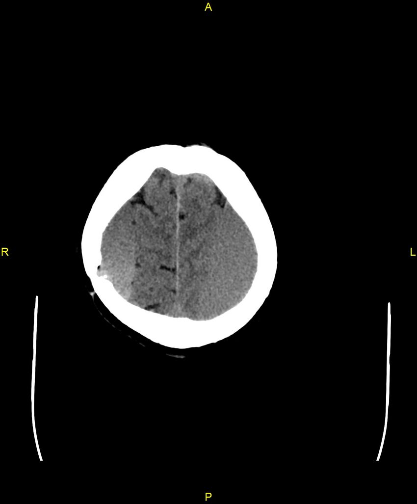 Bilateral isodense subdural hematomas (Radiopaedia 88621-105325 Axial non-contrast 95).jpg