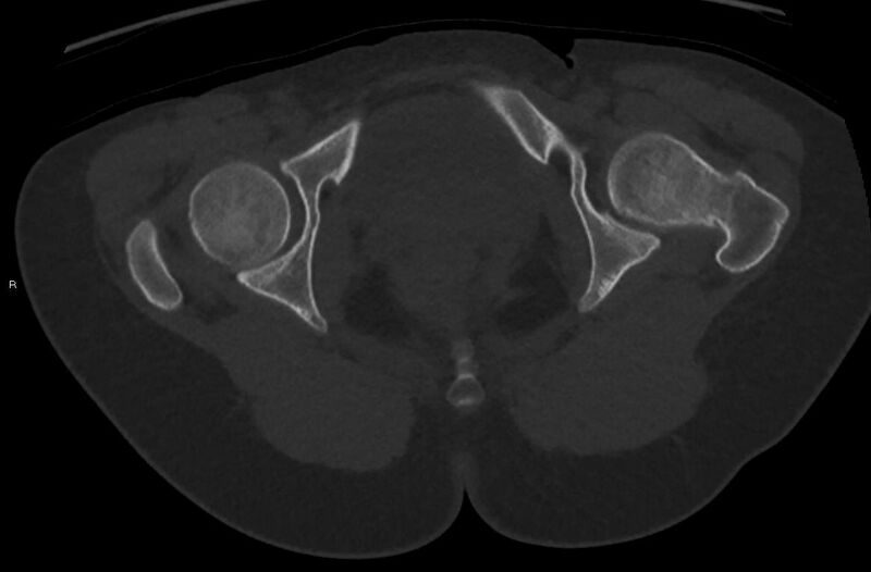 File:Bilateral mature cystic ovarian teratoma (Radiopaedia 88821-105592 Axial bone window 55).jpg