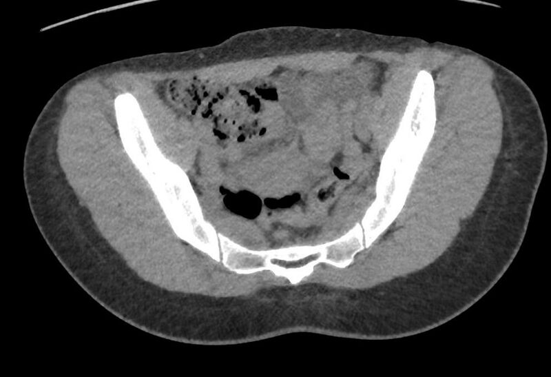 File:Bilateral mature cystic ovarian teratoma (Radiopaedia 88821-105592 Axial non-contrast 8).jpg